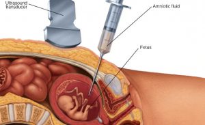 Amniocentoza je invazivna metoda koja nosi mogućnost komplikacija za dijete i majku